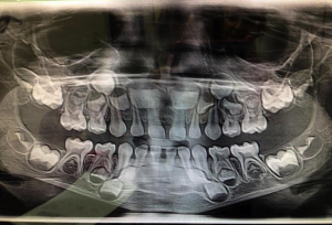 X-ray of Finny’s teeth